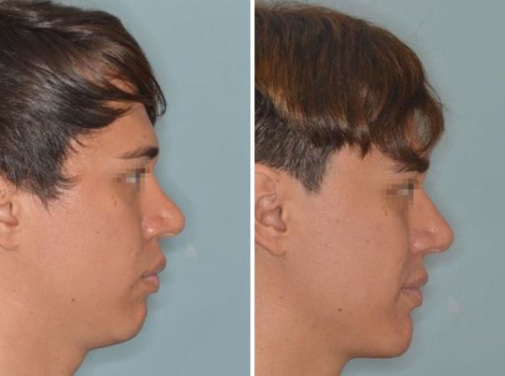 Chin Augmentation Before and After Photos in Miami, FL, Patient 2531