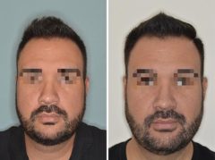 Chin Augmentation Before and After Photos in Miami, FL, Patient 2629