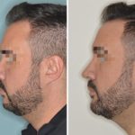 Chin Augmentation Before and After Photos in Miami, FL, Patient 2629