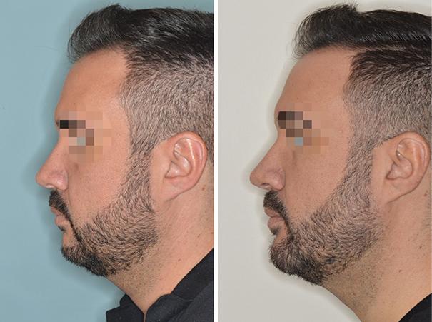 Chin Augmentation Before and After Photos in Miami, FL, Patient 2629