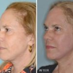 Facelift Before and After Photos in Miami, FL, Patient 2565