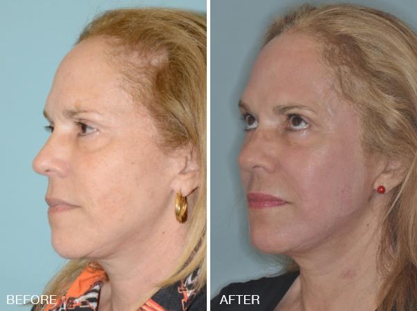 Facelift Before and After Photos in Miami, FL, Patient 2565