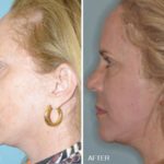 Facelift Before and After Photos in Miami, FL, Patient 2565