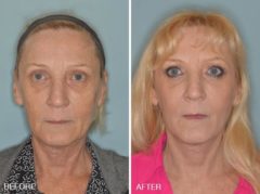 Facelift Before and After Photos in Miami, FL, Patient 2579