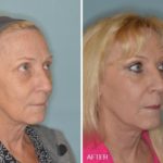Facelift Before and After Photos in Miami, FL, Patient 2579