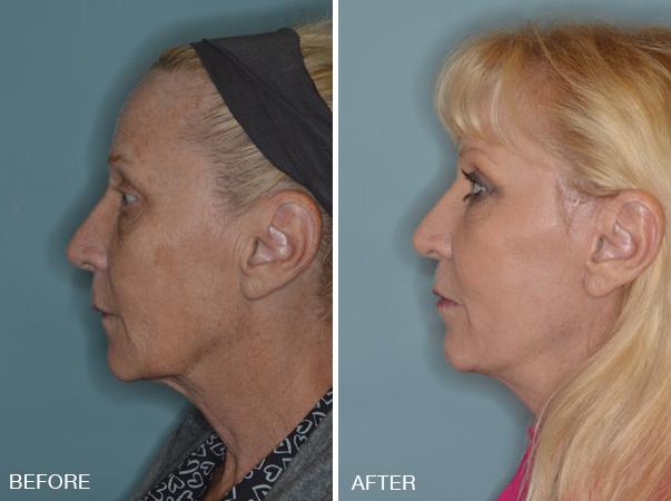 Facelift Before and After Photos in Miami, FL, Patient 2579