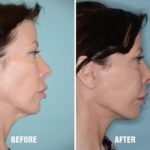 Facelift Before and After Photos in Miami, FL, Patient 2589