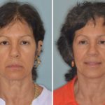 Facelift Before and After Photos in Miami, FL, Patient 2618