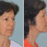 Facelift Before and After Photos in Miami, FL, Patient 2618