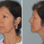 Facelift Before and After Photos in Miami, FL, Patient 2618