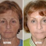 Facelift Before and After Photos in Miami, FL, Patient 2558