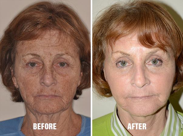 Facelift Before and After Photos in Miami, FL, Patient 2558