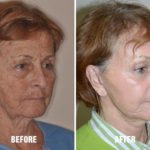 Facelift Before and After Photos in Miami, FL, Patient 2558