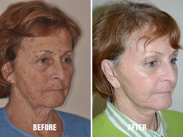 Facelift Before and After Photos in Miami, FL, Patient 2558