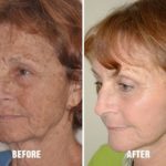 Facelift Before and After Photos in Miami, FL, Patient 2558