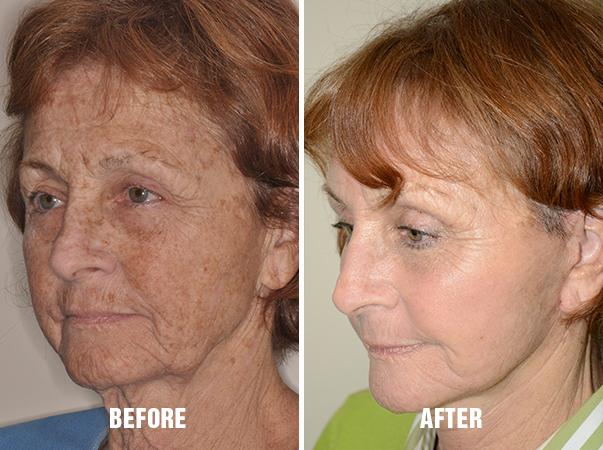 Facelift Before and After Photos in Miami, FL, Patient 2558