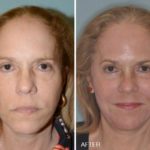 Facelift Before and After Photos in Miami, FL, Patient 2565