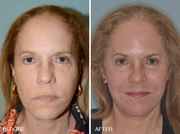 Facelift Before and After Photos in Miami, FL, Patient 2565