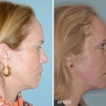 Facelift Before and After Photos in Miami, FL, Patient 2565