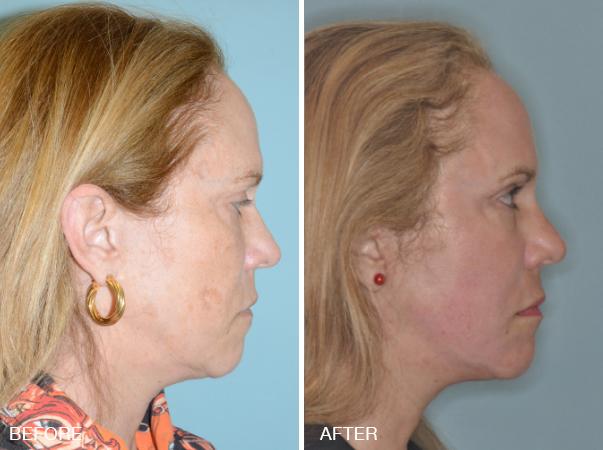 Facelift Before and After Photos in Miami, FL, Patient 2565