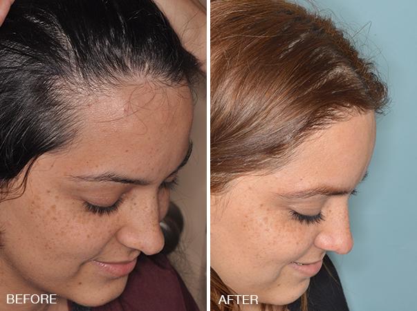 Hair Transplant Before and After Photos in Miami, FL, Patient 2675