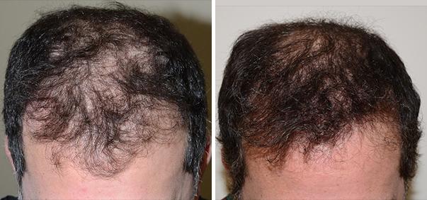 Hair Transplant Before and After Photos in Miami, FL, Patient 2692