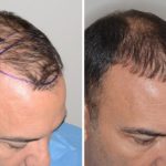 Hair Transplant Before and After Photos in Miami, FL, Patient 2694