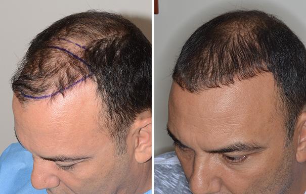 Hair Transplant Before and After Photos in Miami, FL, Patient 2694