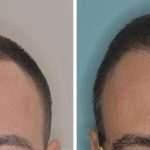 Hair Transplant Before and After Photos in Miami, FL, Patient 2698