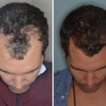 Hair Transplant Before and After Photos in Miami, FL, Patient 2701