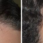 Hair Transplant Before and After Photos in Miami, FL, Patient 2701