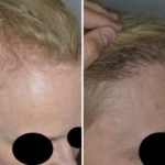 Hair Transplant Before and After Photos in Miami, FL, Patient 2709