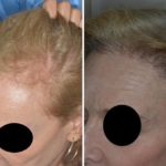 Hair Transplant Before and After Photos in Miami, FL, Patient 2709