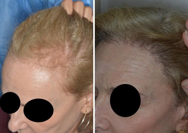 Hair Transplant Before and After Photos in Miami, FL, Patient 2709