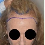 Hair Transplant Before and After Photos in Miami, FL, Patient 2709