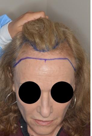 Hair Transplant Before and After Photos in Miami, FL, Patient 2709