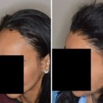 Hair Transplant Before and After Photos in Miami, FL, Patient 2714