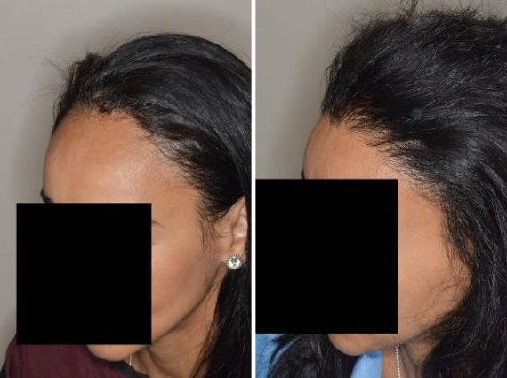 Hair Transplant Before and After Photos in Miami, FL, Patient 2714