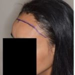 Hair Transplant Before and After Photos in Miami, FL, Patient 2714