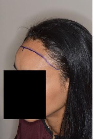 Hair Transplant Before and After Photos in Miami, FL, Patient 2714