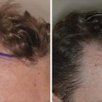 Hair Transplant Before and After Photos in Miami, FL, Patient 2679