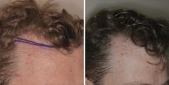 Hair Transplant Before and After Photos in Miami, FL, Patient 2679