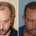 Hair Transplant Before and After Photos in Miami, FL, Patient 2724