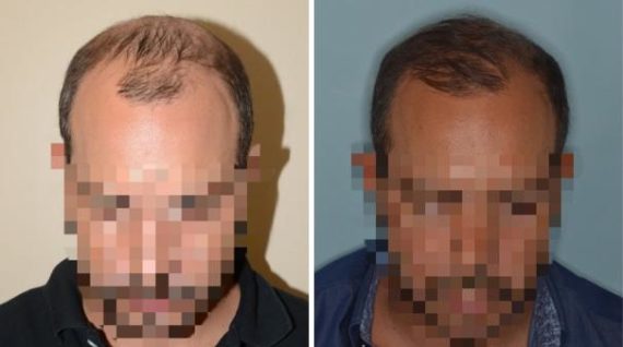 Hair Transplant Before and After Photos in Miami, FL, Patient 2724