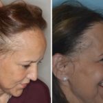 Hair Transplant Before and After Photos in Miami, FL, Patient 2734