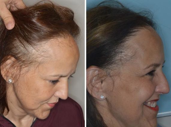 Hair Transplant Before and After Photos in Miami, FL, Patient 2734