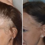 Hair Transplant Before and After Photos in Miami, FL, Patient 2734