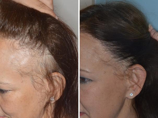 Hair Transplant Before and After Photos in Miami, FL, Patient 2734