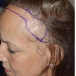 Hair Transplant Before and After Photos in Miami, FL, Patient 2734