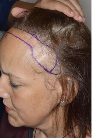 Hair Transplant Before and After Photos in Miami, FL, Patient 2734